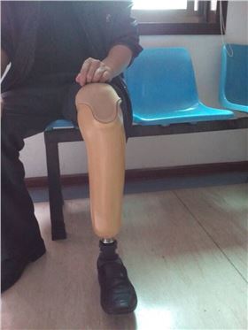 左小腿假肢装配康复案例