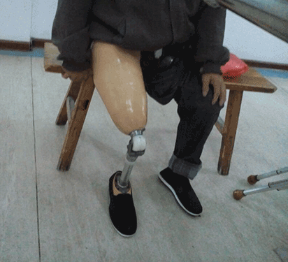 装上大腿假肢能自由活动吗