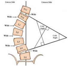 脊柱侧弯角度测量方式之Cobb角测量法 | 佳满假肢