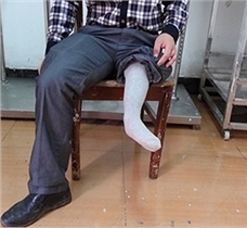 罕见的小腿双畸形假肢案例|湖南佳满假肢