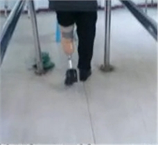 老人下肢假肢小腿假肢行走训练视频|湖南佳满假肢公司