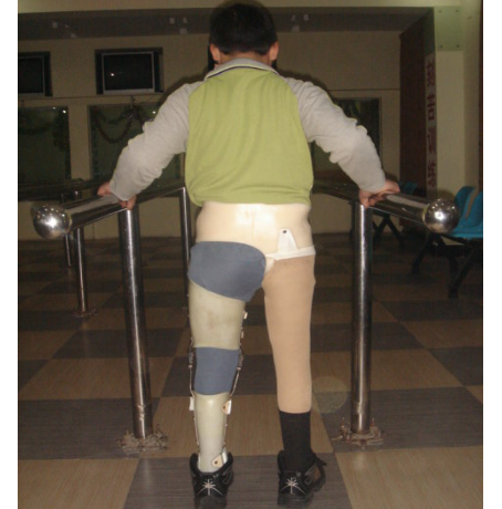 大腿免荷矫形器案例