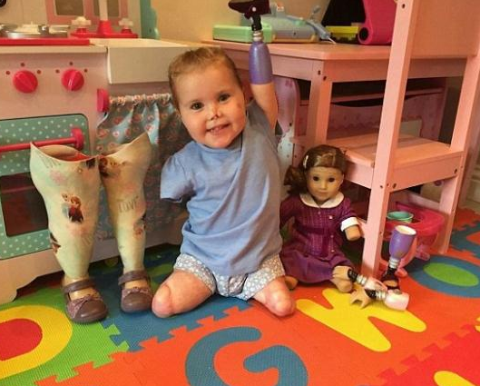 2岁女婴失去四肢 母亲送假肢玩具助其重建信心