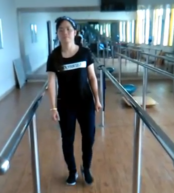 小腿假肢更换试穿视频 小腿假肢更换试穿视频