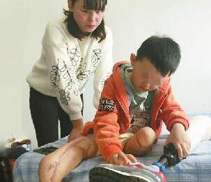 5岁男孩车祸失左腿 爱心企业免费装假肢 5岁男孩车祸失左腿 爱心企业免费装假肢