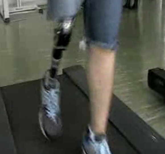 美女用气压关节走出了高档大腿假肢的效果（视频）