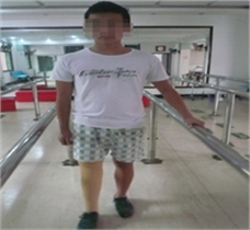 右小腿假肢装配案例