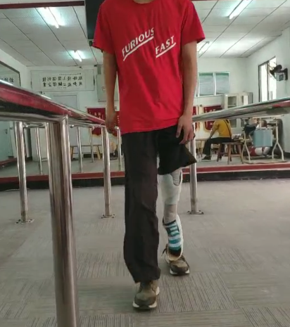 小伙装上了他的特殊假肢|佳满假肢 小伙装上了他的特殊假肢|佳满假肢