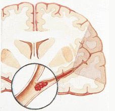 为什么早晨容易发生脑梗？