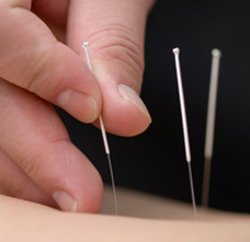 针灸预防保健的发展|佳满假肢