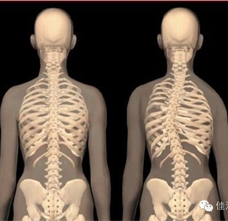 脊柱侧弯矫形器的穿戴方法 | 佳满假肢