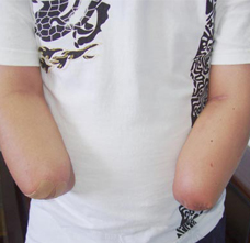 怎样选择前臂截肢后的假肢？ | 佳满假肢