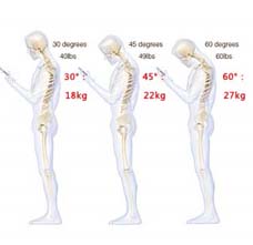 “低头哈腰”颈椎到底有多受伤 | 佳满假肢