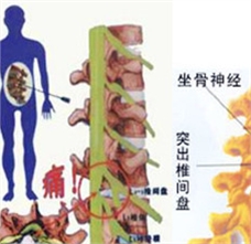 腰椎间盘突出患者怎样注意睡姿和适当的运动