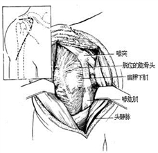 怎样积极预防中老年人的肩周炎以及肩周炎的临床表现